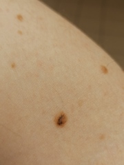 What to do about mole