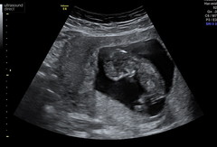 Nub at 12 weeks