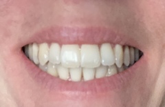 Invisalign