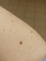 What to do about mole