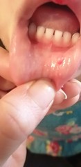 Something on the inside of baby's lower lip (pictures attached)