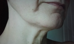 Jowls and jawline