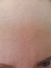 Dermarolling - would it help my skin? (pics included)