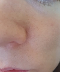 Dermarolling - would it help my skin? (pics included)