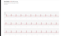Can someone have a look at my ECG please?