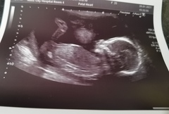 17 weeks Nub theory, help please.