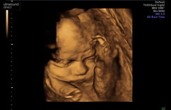 Pregnant After MMC - Thread 4