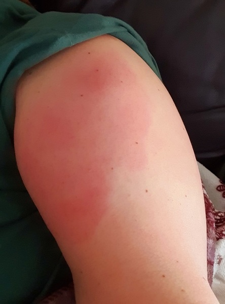 Covid Vaccine and side effects