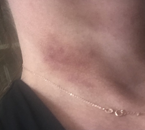 Ultralift /ultherapy - anyone tried it?