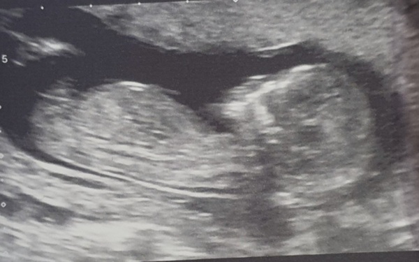 Nub/skull theory guesses, boy or girl. We find out next week 😀