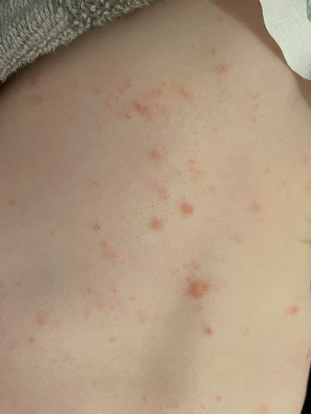 Any idea what this rash could be? Does it look like eczema to you?