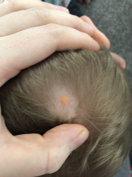 Orange scalp spots