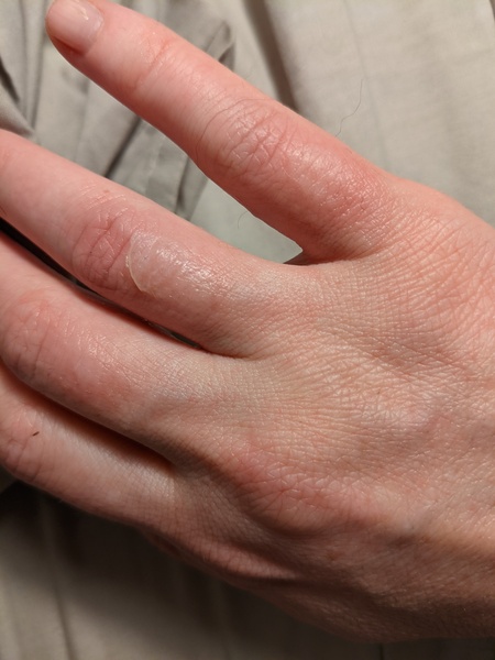 Burnt hand, NHS website says A+E?!