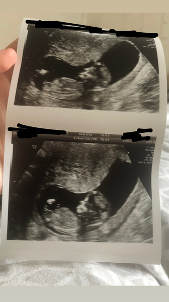 Girl or boy? What do you think? 12 week and 3 days.