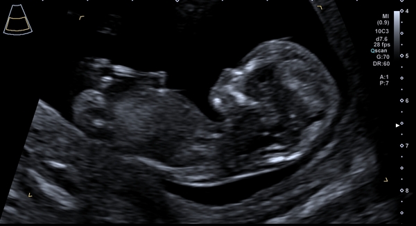 Do you want me to guess the sex? 12 week scans.