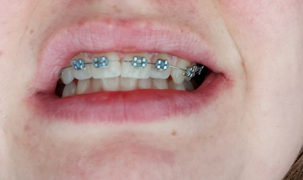 I have fixed metal braces AMA