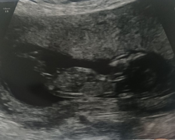 Boy or girl? 20 week scan
