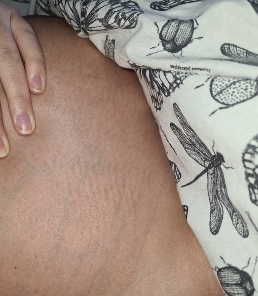Are these stretch marks? 😳