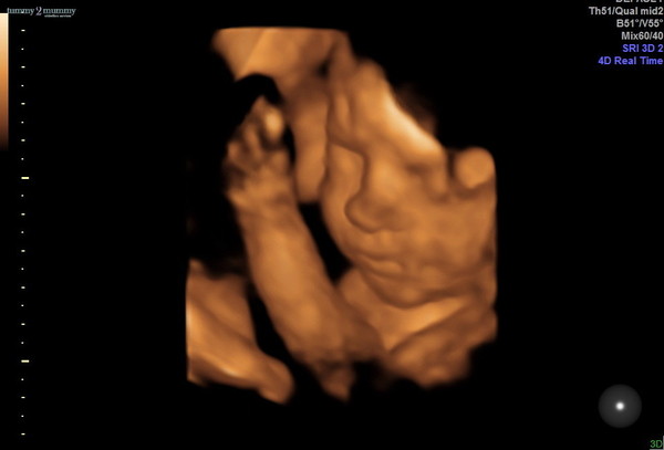 Pregnant After MMC - Thread 5