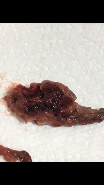 What on earth is this that just came out of me? **pic included** sorry if tmi