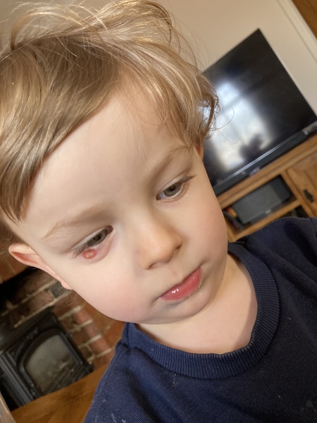 Toddler with chalazion on eye (picture)