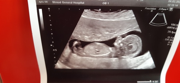 Do you want me to guess the sex? 12 week scans.