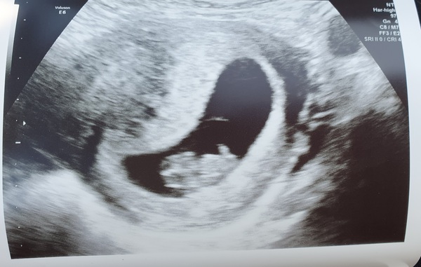 Pregnant after miscarriage