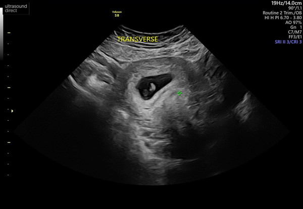 What side is my placenta?
