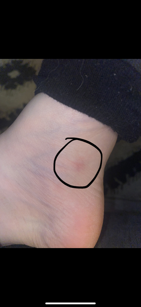 Painful red blotch on sole of foot