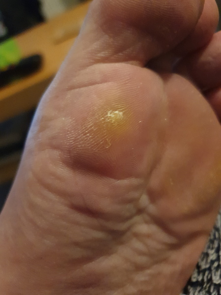What is this on my foot?