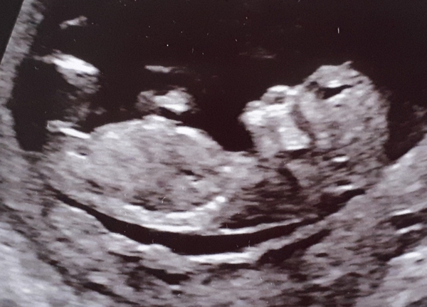 Do you want me to guess the sex? 12 week scans.