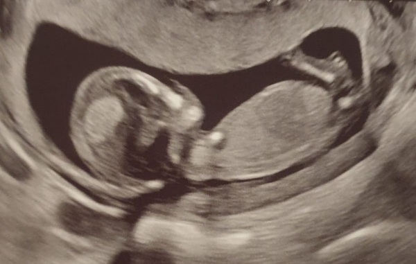 Do you want me to guess the sex? 12 week scans.