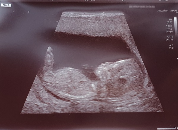 Do you want me to guess the sex? 12 week scans.