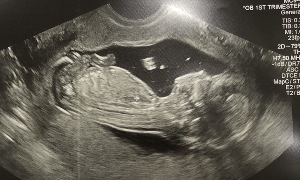 Do you want me to guess the sex? 12 week scans.