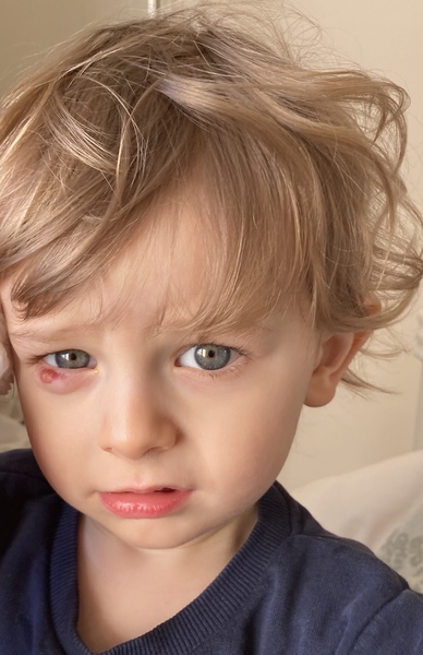 Toddler with chalazion on eye (picture)