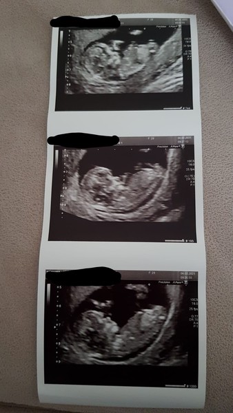 Do you want me to guess the sex? 12 week scans.