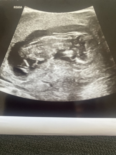 12 week scan! Need another pair of eyes!