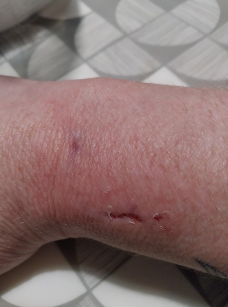 Ddog attacked and bit me