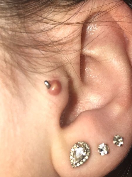 To ask how to get rid of irritation bump on tragus