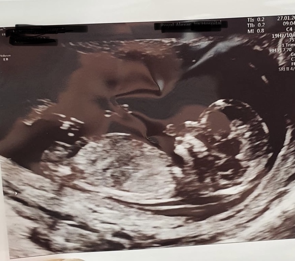 Do you want me to guess the sex? 12 week scans.
