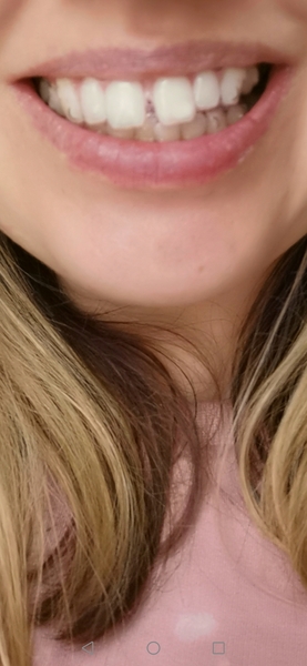 I've just started my invisalign today need  reassurance....