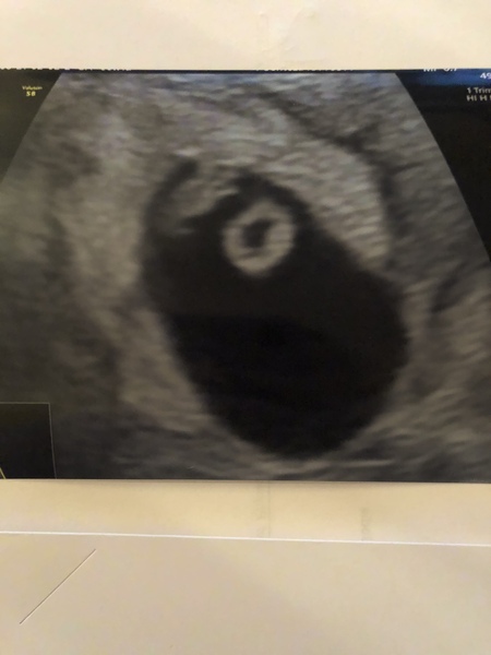 Private early scan?