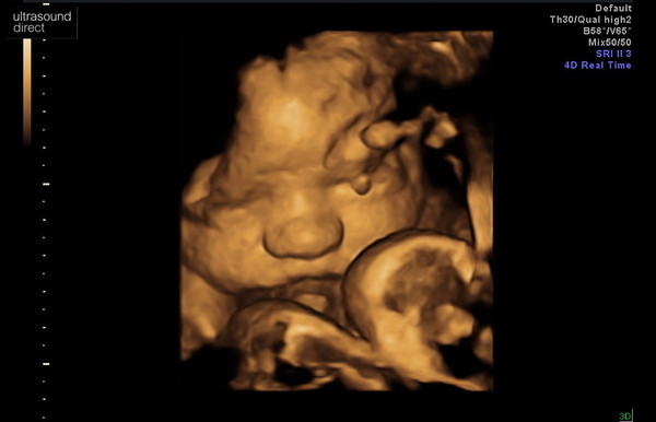 Pregnant After MMC - Thread 5