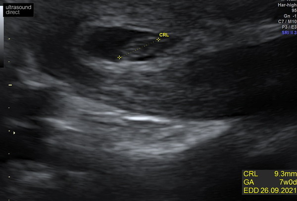 Private early scan?