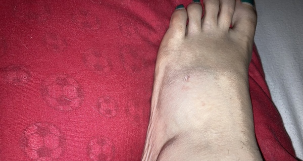 Could my foot be broken?