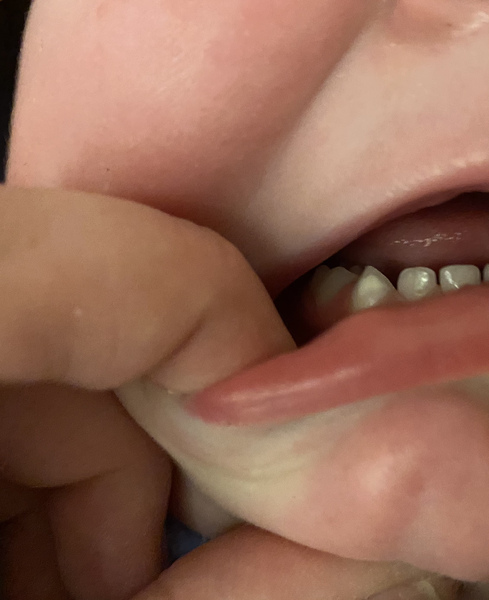 23 months Tooth