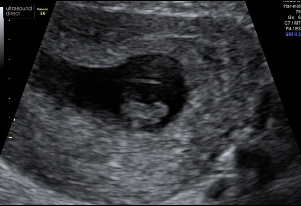 Private early scan?