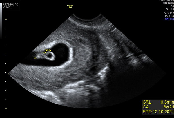 Bicornate Womb?