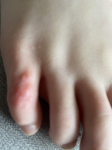 Blisters on toes