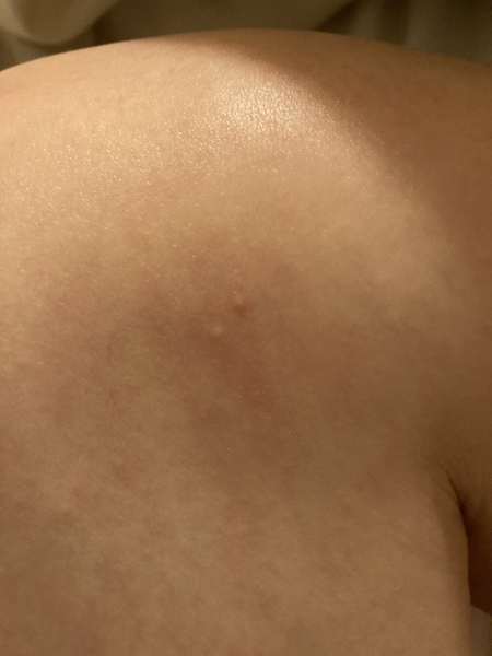 Itchy